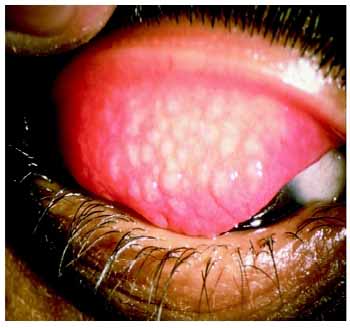 sex therapy chlamydia eye infection called as Trachoma
