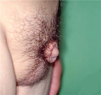Hypogonadism
