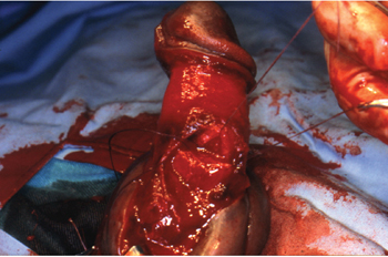 Penis injury repair by surgery