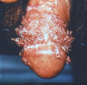 sex therapy HPV (Human Papilloma Virus) infection and warts in a man on penis