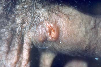 sex therapy herpes simplex male penis infection